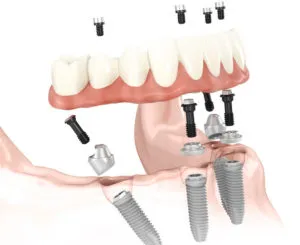 image of all on fours implants
