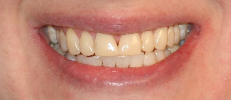 SVETLANA CLOSE UP SMILE BEFORE SMILE MAKEOVER WITH PORCELAIN VENEERS