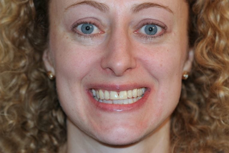 SVETLANA SMILE BEFORE SMILE MAKEOVER WITH PORCELAIN VENEERS