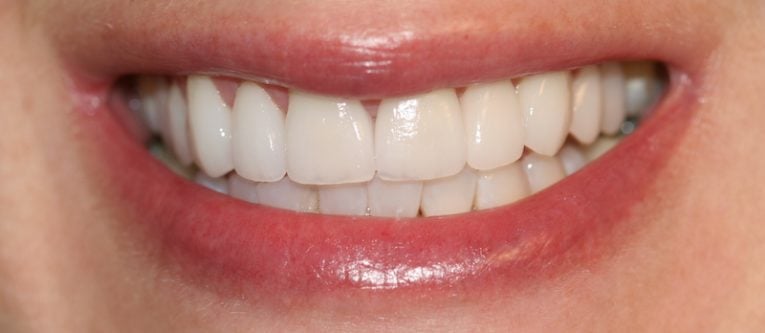 SVETLANA CLOSE UP SMILE AFTER SMILE MAKEOVER WITH PORCELAIN VENEERS