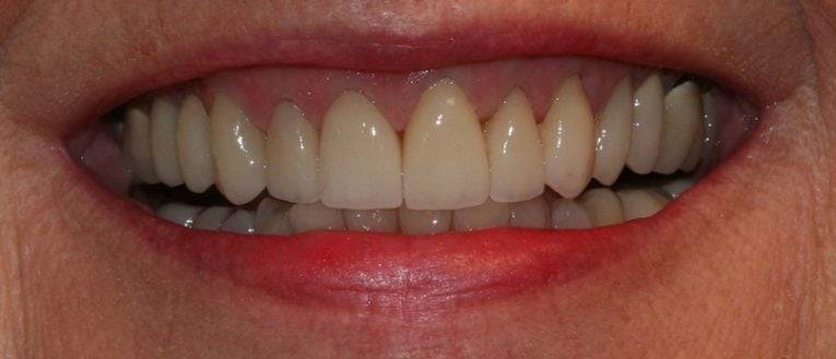 Helen's smile after smile makeover with veneeres