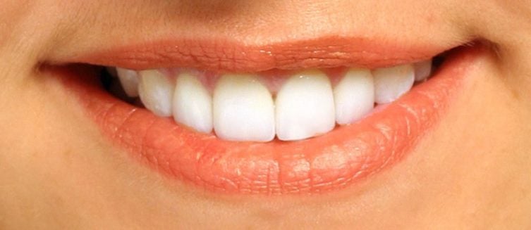 Elizabeth close up smile after REPLACING OLD BONDING WITH PORCELAIN VENEERS