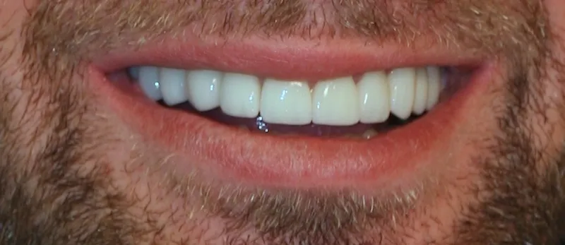 BRENDAN smile after FULL MOUTH MAKEOVER WITH VENEERS
