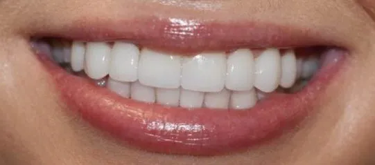 After cosmetic dentistry photo