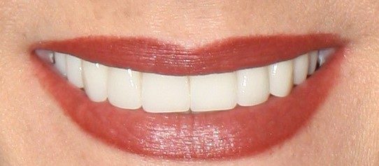 Smile Gallery - Dani After