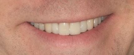 After cosmetic dentistry