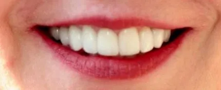 after image of cosmetic dentistry