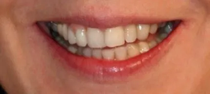 before image of cosmetic dentistry