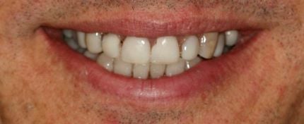 Before cosmetic dentistry