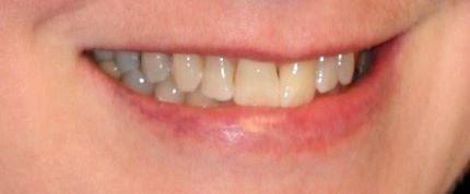 before image of cosmetic dentistry