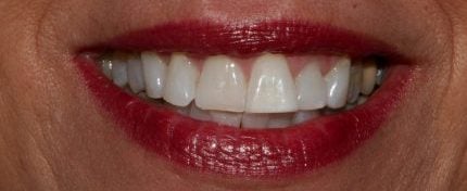 before image of cosmetic dentistry