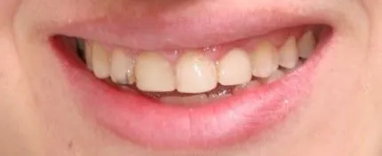 before image of cosmetic dentistry