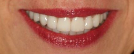 after image of cosmetic dentistry