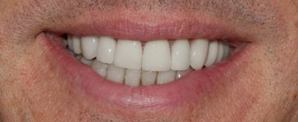 after cosmetic dentistry