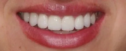 after image of cosmetic dentistry