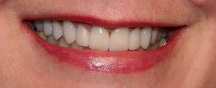 after image of cosmetic dentistry
