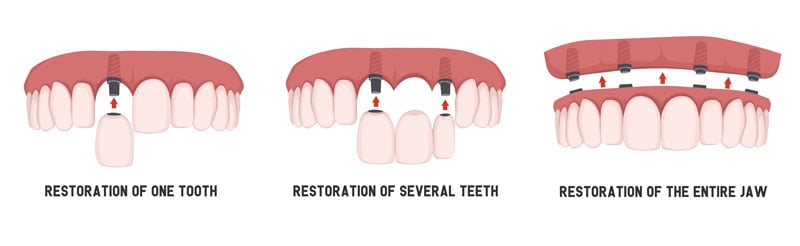 One implant, fixed dental bridge, and full mouth dental implants compared