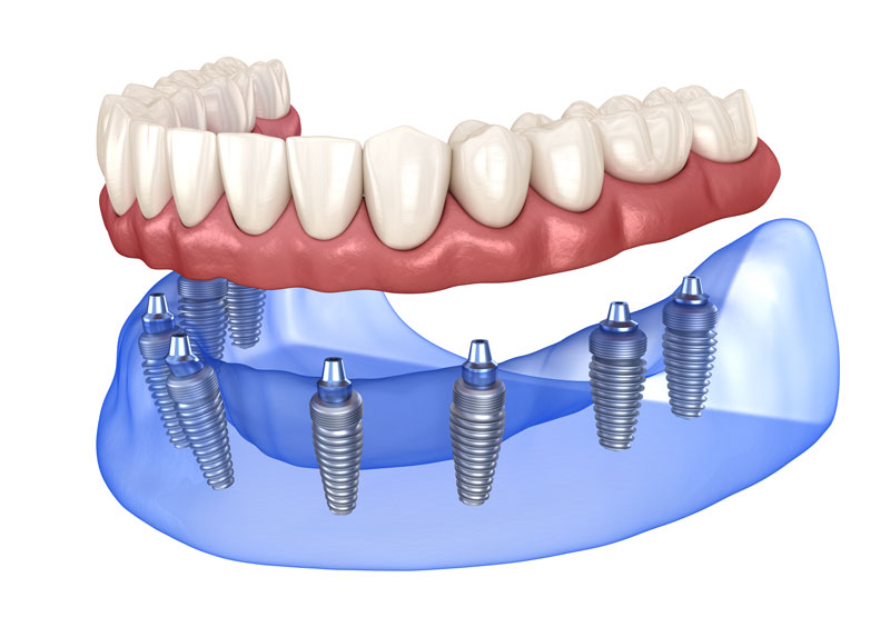 Full mouth dental implants for lower arch.
