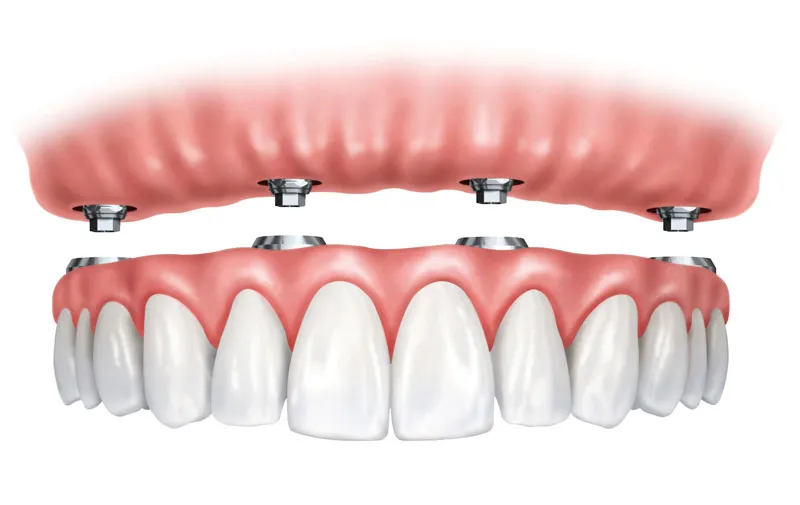 snap on dentures